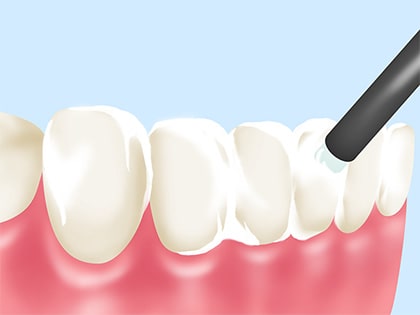 フッ素塗布～虫歯に負けない強い歯を