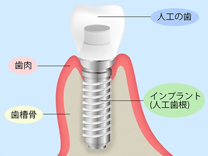 天然歯のような噛み心地が戻ってくるインプラント