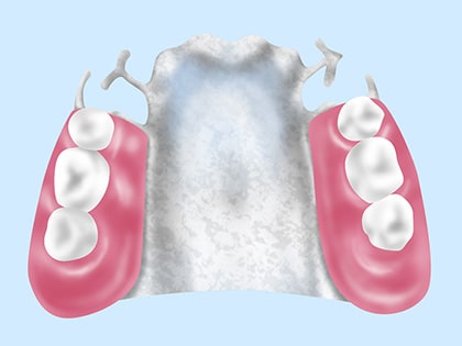 自費診療の入れ歯