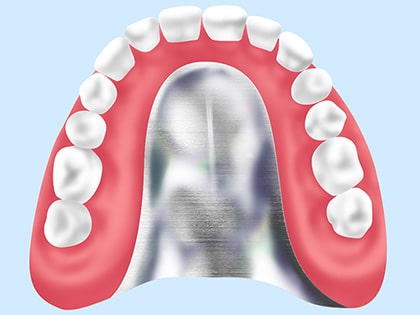 金属床義歯
