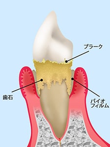 歯周病とは……？